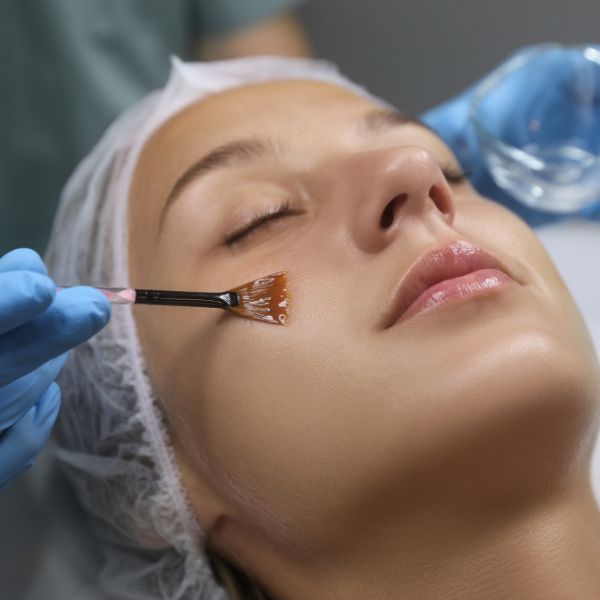 jmed spa chemical peel 2