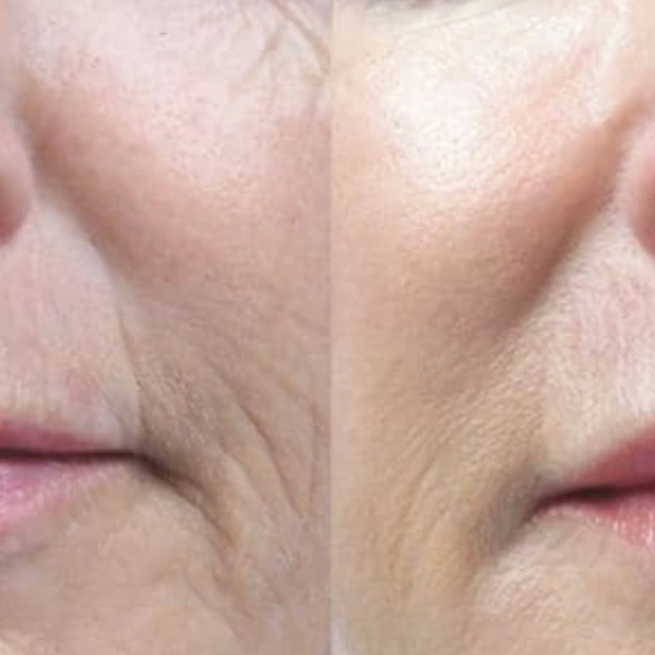 jmed spa sublative before and after
